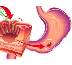 Причины и первые признаки возникновения язвы желудка