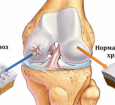 СКРИПЯТ колени, болят суставы: это средство ВОССТАНОВИТ коллаген