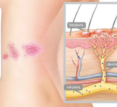 Опоясывающий герпес: что нужно знать о стригущем лишае?