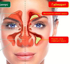 Пять природных средств для защиты от синусита