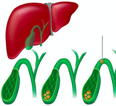 Избавление от  камней и лечение желчного пузыря народными методами