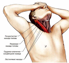 Как проявляется синдром передней лестничной мышцы и к чему приводит? 