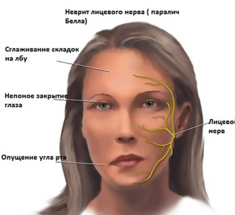 Лечебная гимнастика при НЕВРИТЕ лицевого нерва