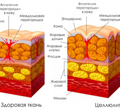 5 самых эффективных упражнений для борьбы с целлюлитом