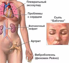 Красная волчанка: 7 домашних способов борьбы с заболеванием