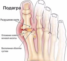 Подагра: не относитесь легкомысленно!