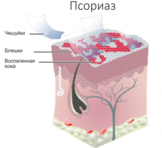 Псориаз: 15 рекомендаций для борьбы с заболеванием