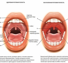 Ангина летом: 7 примет болезни, которые нельзя игнорировать!