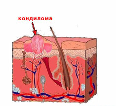 Лечение остроконечных кондилом народными средствами 