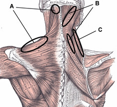 Карта триггеров: точки боли и точки напряжения мышц 