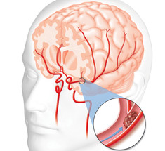 Мозговая катастрофа: Что ведёт к инсульту