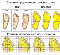 Как определить плоскостопие в домашних условиях