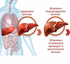 Мягкое очищении печени по методике Андреаса Морица