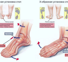 Как исправить плоскостопие