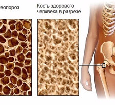 Кому грозит остеопороз