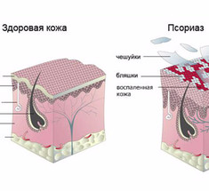 Псориаз — не заболевание кожи!