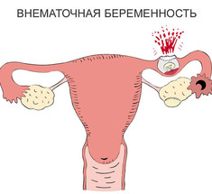 Первая помощь при внематочной беременности