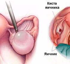 Кисты яичника: 9 тревожных сигналов 