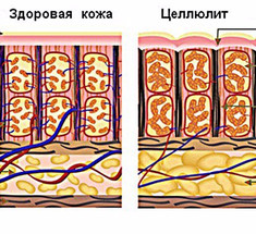 Крема от целлюлита: работают ли разрекламированные средства?