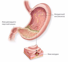 Лечение язвы желудка по методу Марвы Оганян