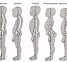 Как плаванием исправить нарушения осанки