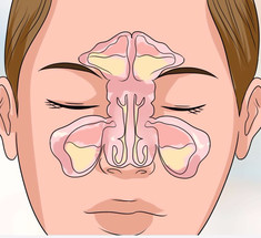 Как БЫСТРО вылечить воспаление носовых пазух БЕЗ лекарств