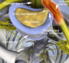 Архиважная статья! Остеохондроз и грыжа диска — истинные ПРИЧИНЫ болей и иных осложнений