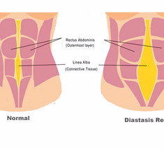 Диастаз прямых мышц живота: Кто виноват и что делать