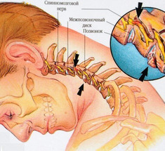 Это важно знать! Основные симптомы шейного остеохондроза