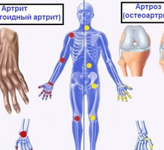 Это нужно знать: Разница между артрозом, артритом и остеопорозом