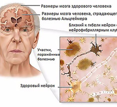 Зараженное мясо может быть причиной болезни Альцгеймера