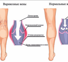 Варикозное расширение вен: упражнения Микулина