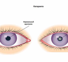 8 важных вещей, которые нужно знать о катаракте