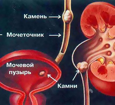  5 шагов для предупреждения камнеобразования в почках