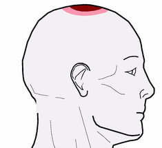 Почему болит макушка головы