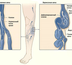 8 упражнений против варикоза