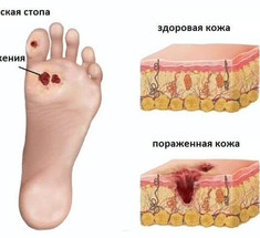 ДИАБЕТИЧЕСКАЯ СТОПА: симптомы и лечение