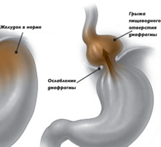ГРЫЖА ПИЩЕВОДА: Народные средства лечения