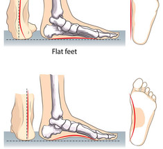 ПЛОСКОСТОПИЕ: упражнения, которые помогут исправить ситуацию