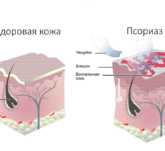 ПСОРИАЗ: натуральный рецепт для лечения