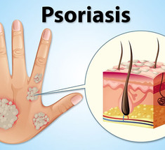 ПСОРИАЗ — больше, чем поверхностное заболевание кожи