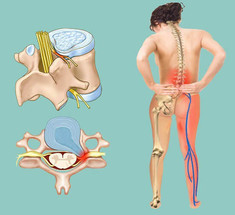 Межпозвонковая ГРЫЖА: Лечение народными средствами
