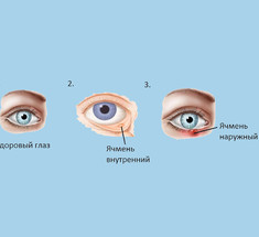 Ячмень на глазу: 8 актуальных и безопасных способов борьбы 