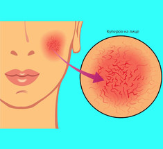 КУПЕРОЗ: Как избавиться от красной сосудистой сетки на лице