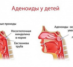 Как избавиться от аденоидов: 2 простых совета 