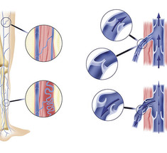 Венозная недостаточность: Полезные советы, позволяющие снизить риск