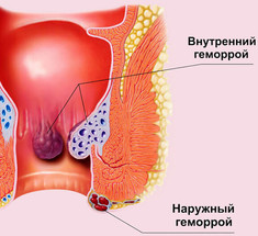 Лучшие советы для облегчения симптомов геморроя