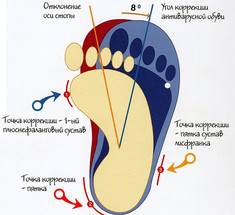 Косолапость или варусная деформация стоп