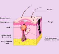 Как лечить прыщи: 6 мощных домашних средств от акне