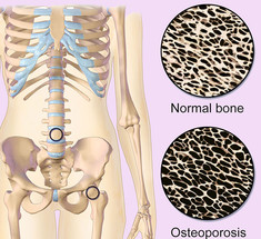 Как предотвратить остеопороз